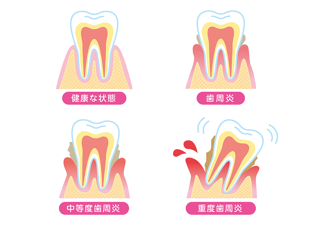 歯周病治療